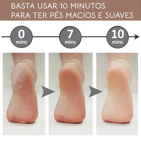 Lixa Para Retirar Calos Do Calcanhar - Derma Skin